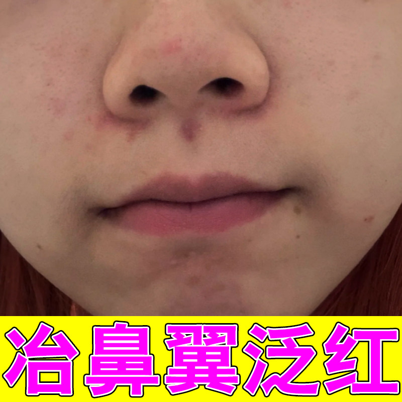 冶鼻翼两侧泛红起干皮掉屑外用草本软膏鼻子红肿发痒换季皮肤过敏