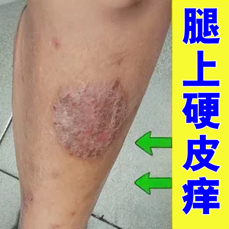 小腿皮肤痒腿部干燥起皮腿上长红斑全身痒干燥外用草本修护软膏