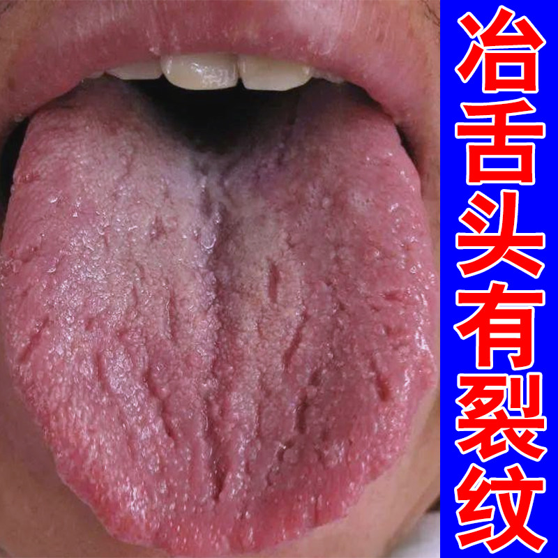 舌头有纹口腔麻木舌面白厚草本修护喷剂冶舌头有纹疼痛舌苔泛白