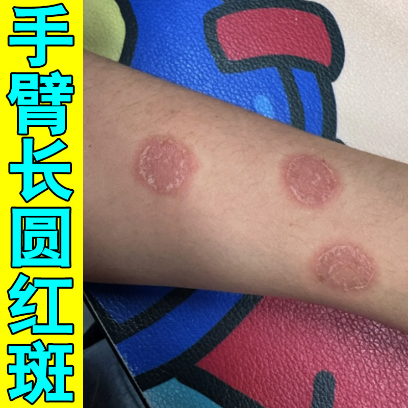 冶手臂长铜钱状圆红斑皮肤干燥粗糙感染发痒草本修护软膏手臂红斑