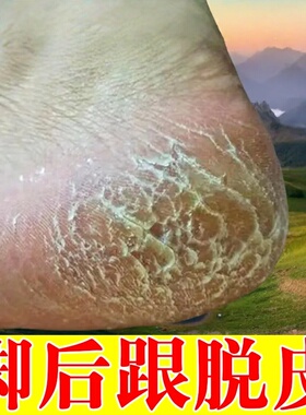 鳞屑角化型脚痒气脚后跟干裂皲裂去死皮起硬皮感染角质增厚修复药
