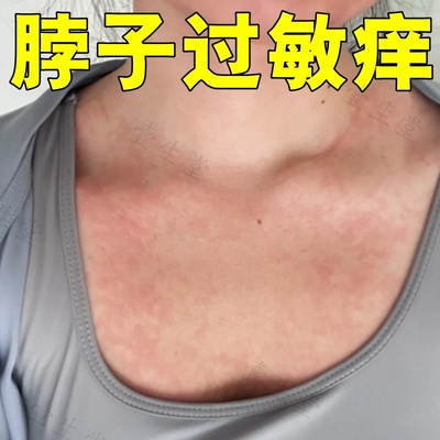 脖子过敏痒瘙颈部皮肤出汗红肿起疹子药神经性炎刺挠起疙瘩外用膏