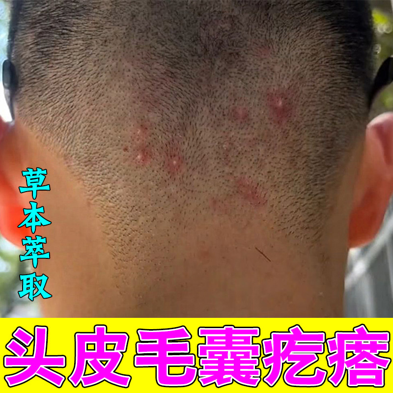 头皮长毛囊疙瘩痘痘皮肤红痒草本修护软膏毛囊堵塞头皮发痒有疙瘩