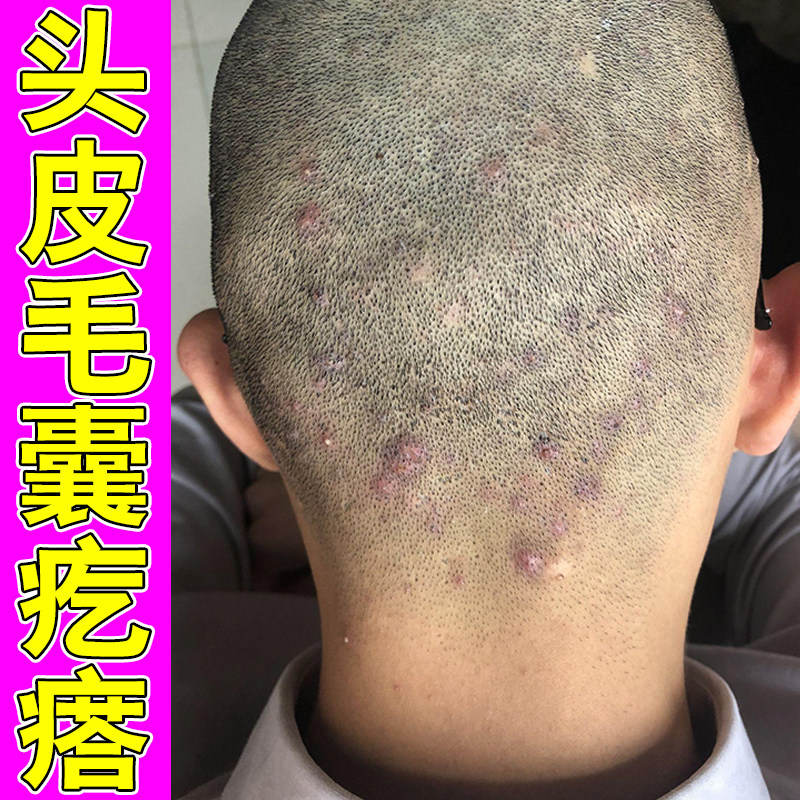 头皮上长痘痘毛囊疙瘩专用草本修护软膏后脑勺长硬疙瘩皮肤感染