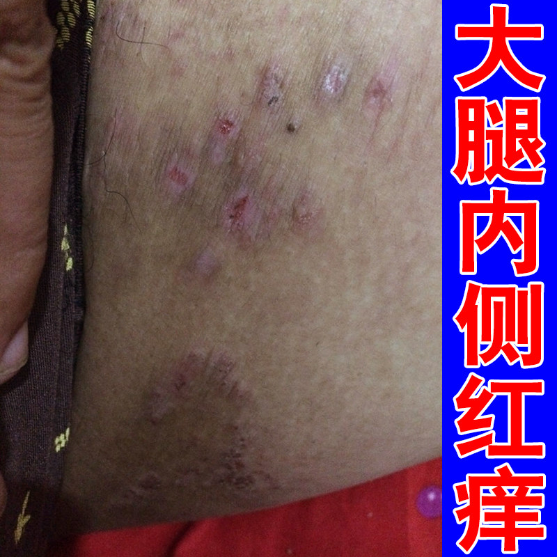 私处长红斑疙瘩干痒皮肤感染红痒专用草本膏男人下面痒大腿根红斑
