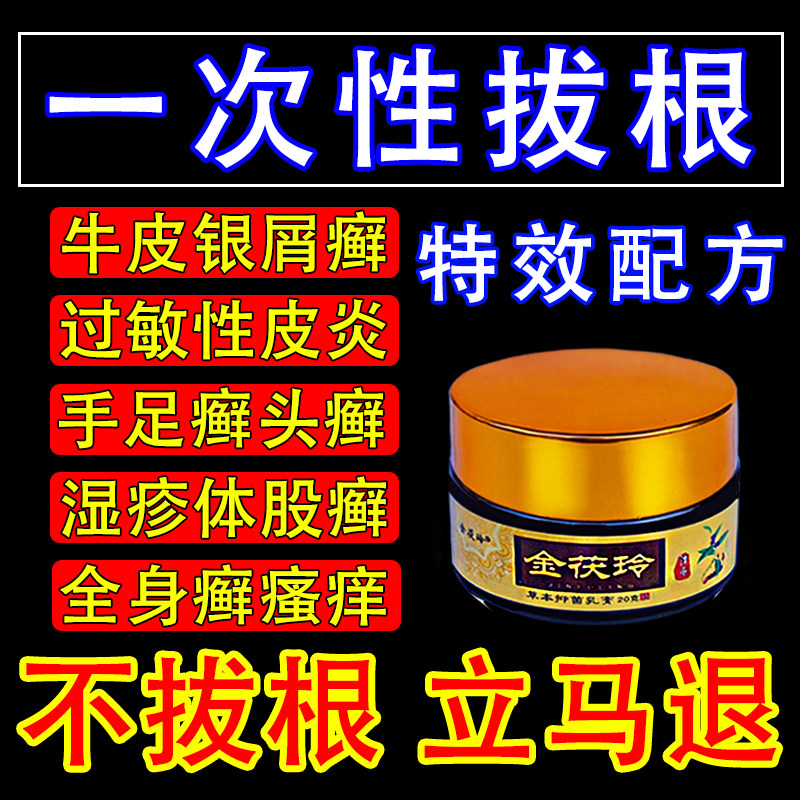 牛皮藓银屑病疹湿皮肤专用去止痒保健理疗