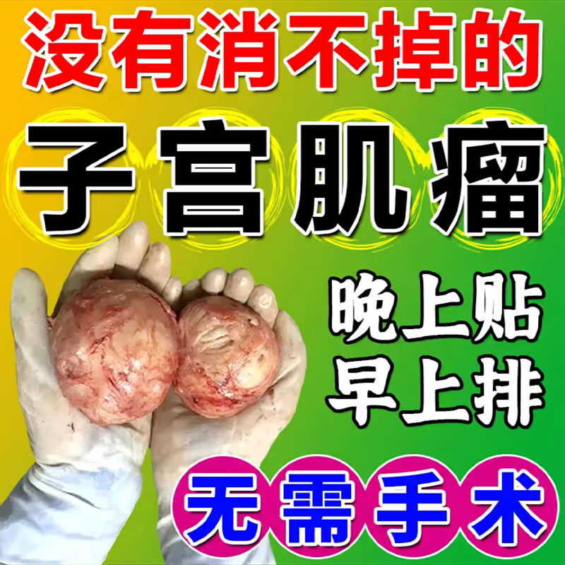 子宫肌瘤中药贴消除治疗内膜息肉宫瘤清巧克力囊肿腺肌症输卵管堵