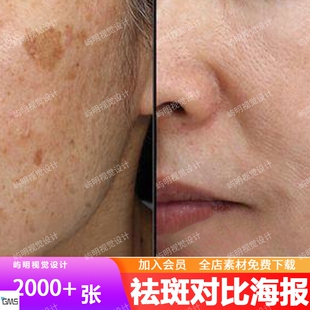 祛斑前后对比图美容院祛痘祛除老年黄褐斑实拍高清素材图JPG图片