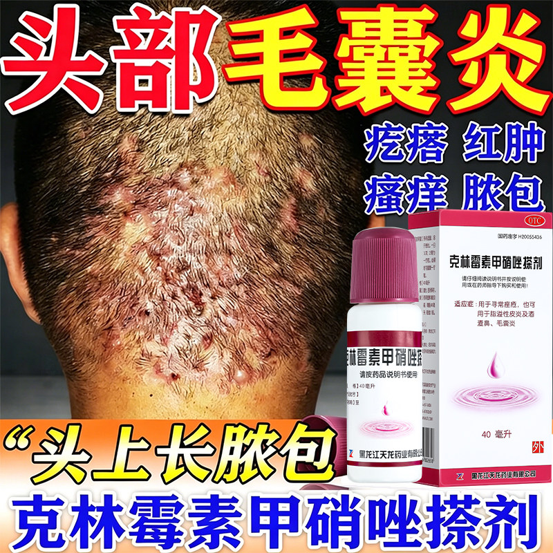 【天龙】克林霉素甲硝唑搽剂0.8%1%*40ml*1瓶/盒