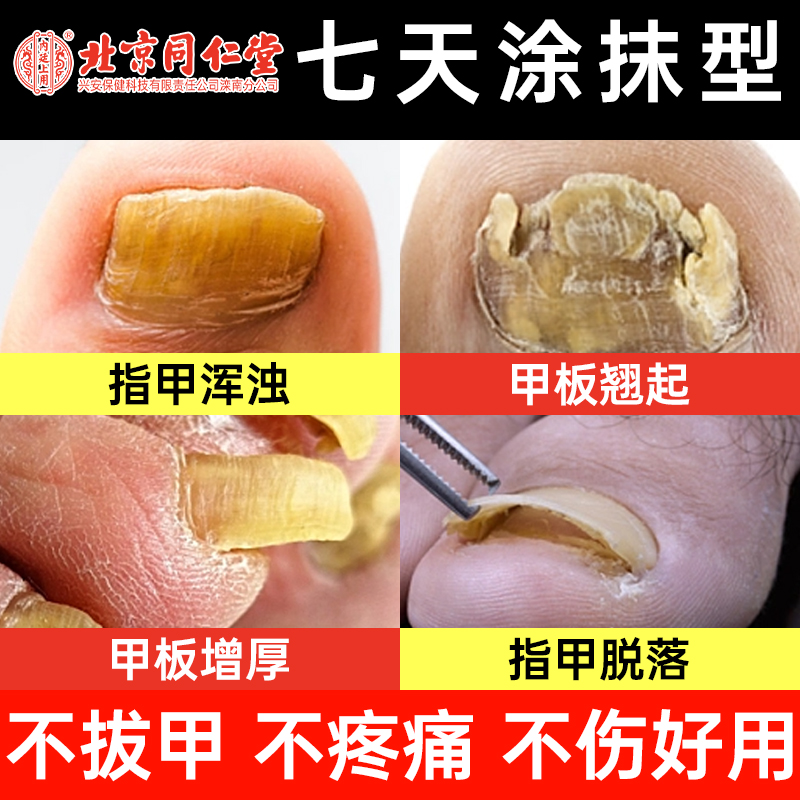 同仁堂灰指甲专用亮甲抑菌液脱甲脚趾治疗去除增厚药房旗舰店正品