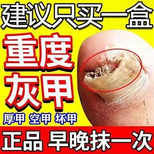 治疗灰指甲特专用效药环吡酮胺乳膏正品官方旗舰店抗真菌感染药膏