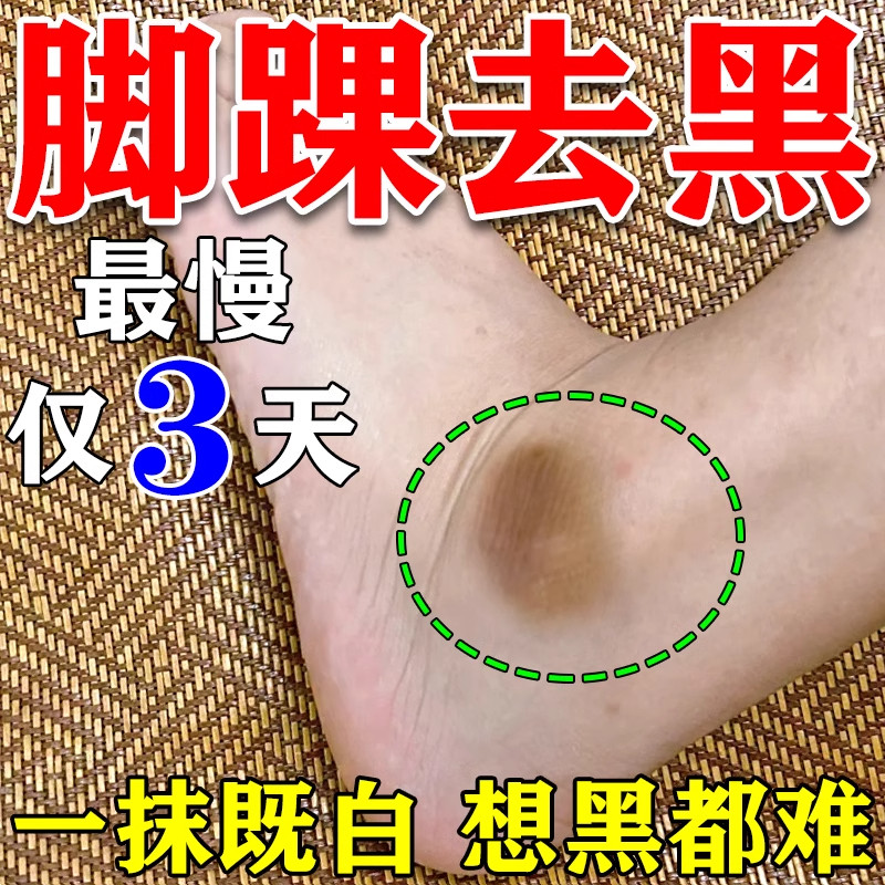 脚踝发黑脚脖子去黑除腋下脖子指关节膝盖手肘黑色素沉淀白神器图片