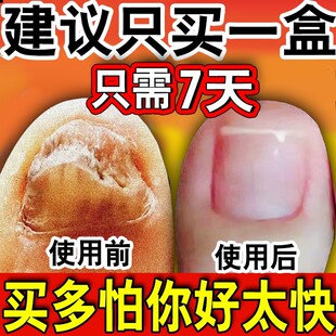 脚指甲增厚灰指甲专用膏药重度厚甲脚趾手指灰指甲正品专用灰甲净