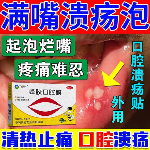 蜂胶口腔膜反复口腔溃疡炎症发口疮溃疡贴止痛烂嘴起泡缺维生素tw