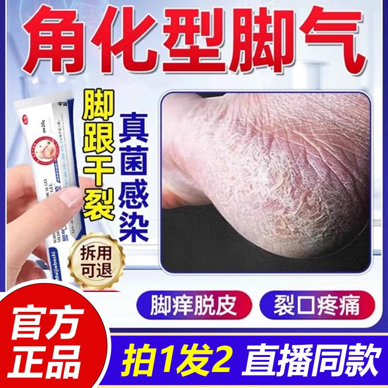 去角化型脚气脚后跟干裂开裂脱皮用专特杀菌真菌感染止根效痒1VP
