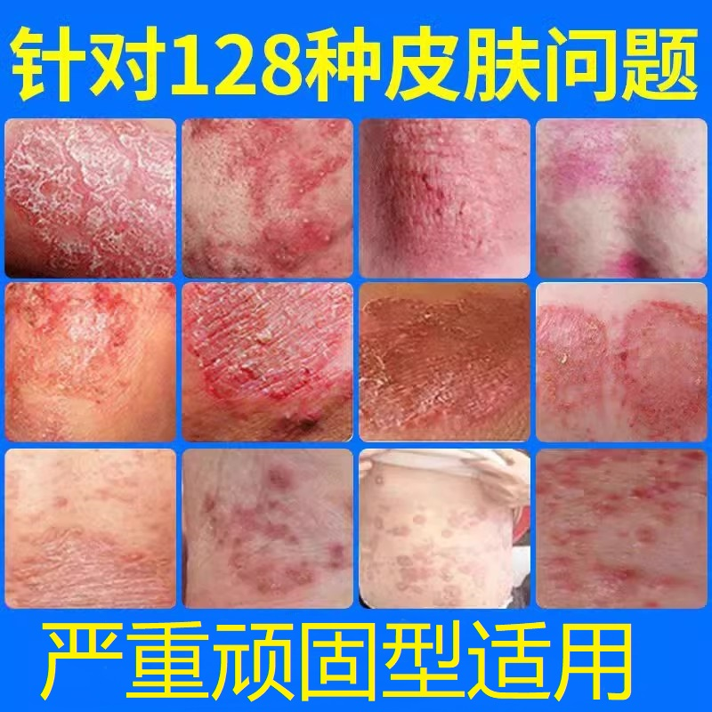 香港断痒灵痒止膏身上痒皮肤痒瘙湿止痒正品抑菌外用乳膏特效bp