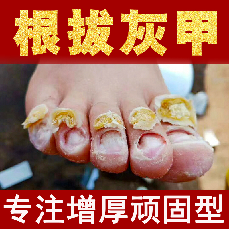 灰指甲8天涂抹型不修剪自然脱落