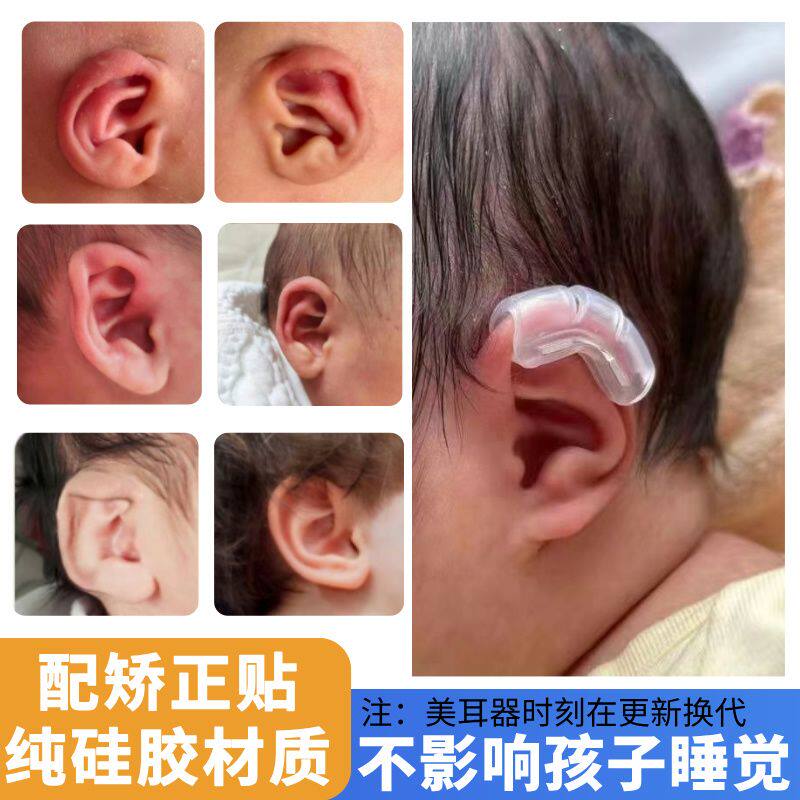 新生儿耳朵矫正器婴廓支