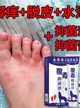 达克宁盐酸特比萘芬喷雾剂手足藓体股癣达克灵手脚癣脚气脚气止痒