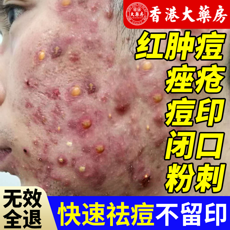 祛痘膏祛痘印修复淡化痘印青春痘去痘膏正品闭口粉刺男女学生专用