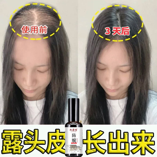 非那雄胺法保止保止法男性激素脱发严重男专用默沙东非纳雄胺片