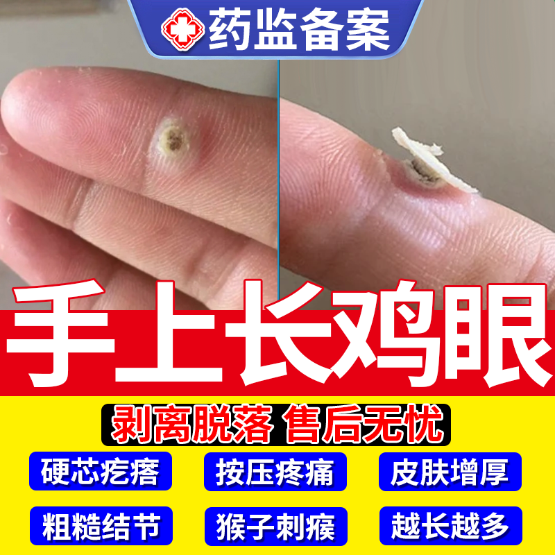 手上长硬疙瘩去疣鸡眼贴手指寻常疣除刺猴根瘊子专用神器去除贴JW