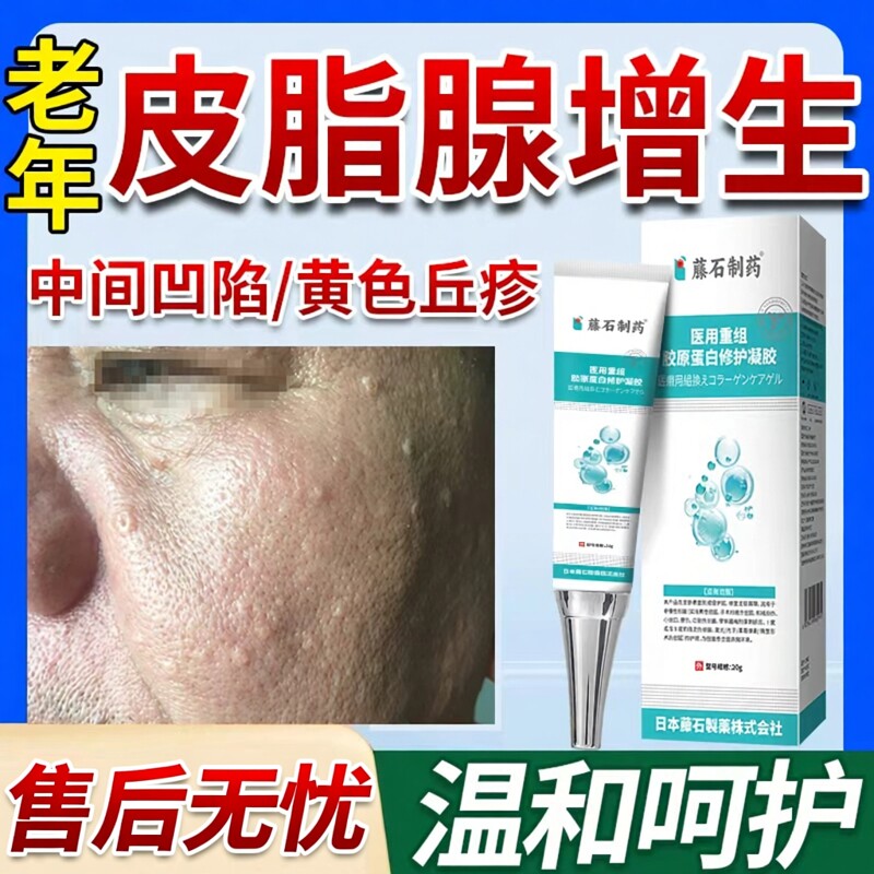 脸上老年性皮脂腺增生痣药房同款膏去皮肤上起小疙瘩皮质肉疙瘩EM