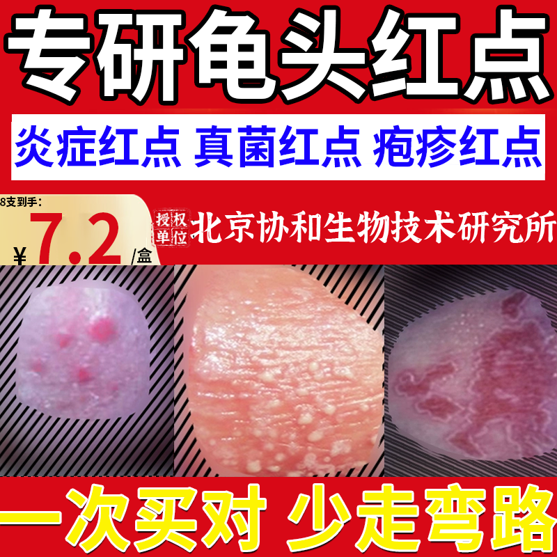 龟头炎真菌感染上有红点斑红肿裂口白垢包皮瘙痒脱皮粘膜异味bsd