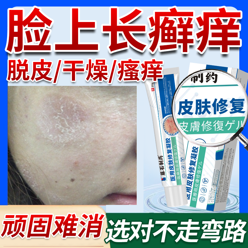 脸癣痒专用皮癣薬房款膏脸上藓用脸部牛皮癣脱皮面部真菌感染OZ