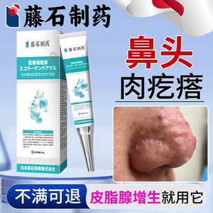 鼻子上肉疙瘩滕石腾石藤石制药再合成鼻头鼻翼脂肪粒皮脂腺增生OZ