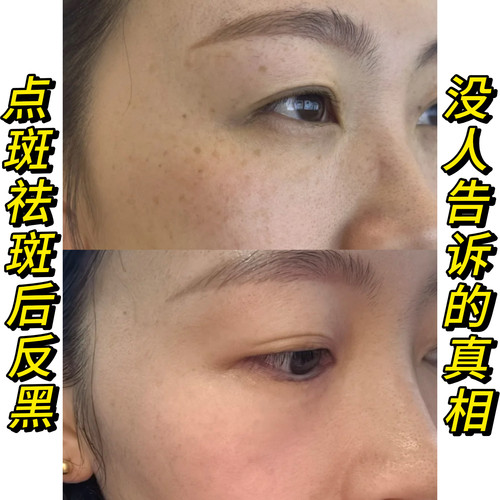 医续美】祛斑后反黑修复控色