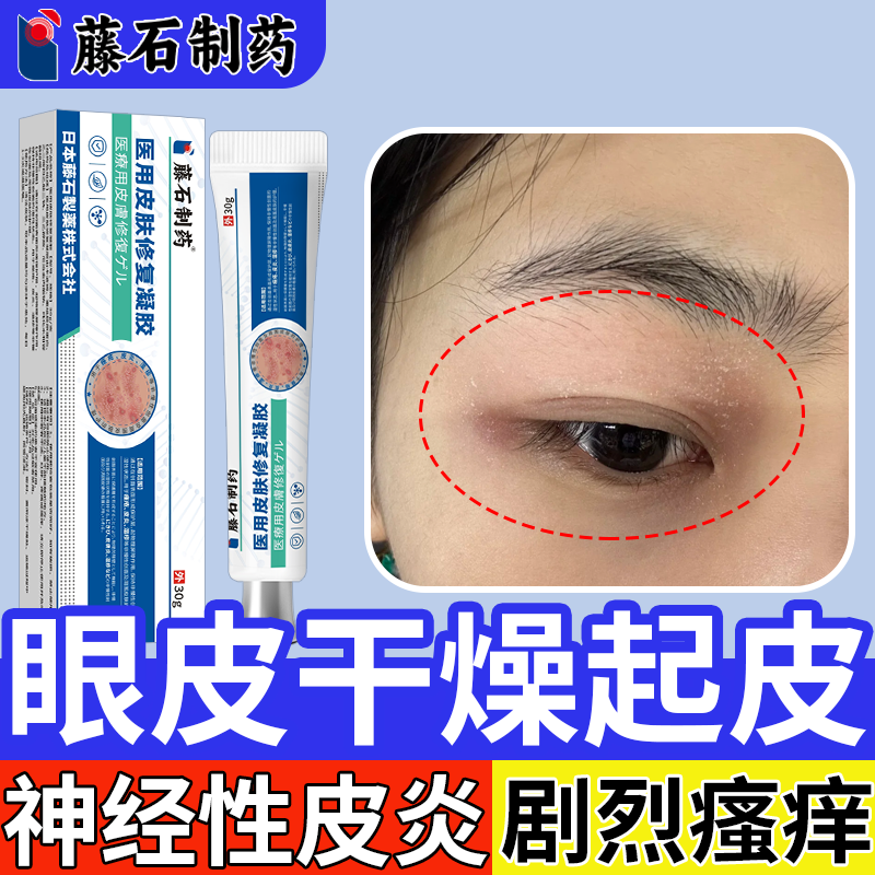 眼皮癣神经性皮炎专用止痒修复膏