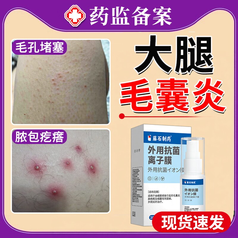 大腿毛囊炎腿部腿上毛孔堵塞细菌性马拉色菌专用喷雾剂薬房同款JW