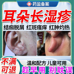 耳朵痒脂溢性皮炎软膏外耳道真菌感染湿疹止痒耳后去皮屑脱皮根JW