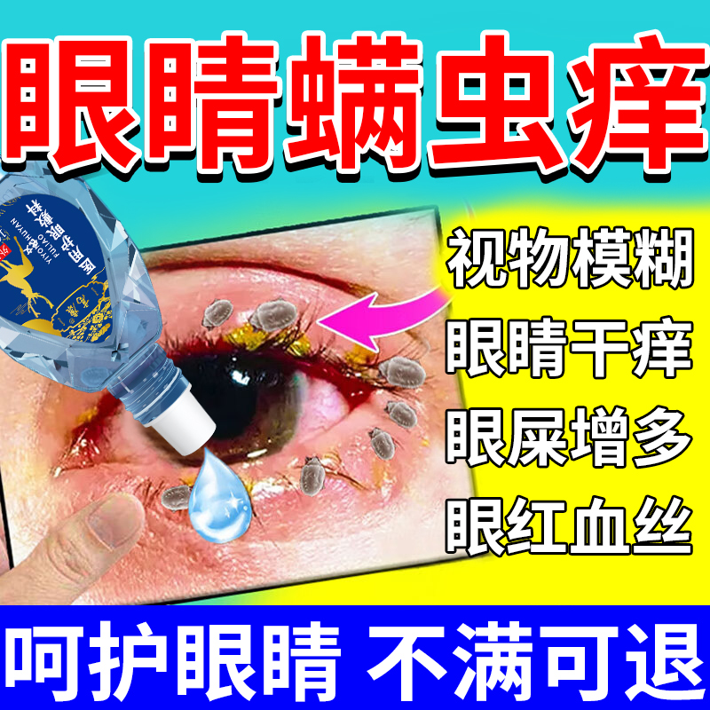 【眼睛螨虫痒】眼干眼痒红血丝