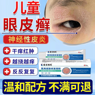 儿童眼皮癣眼睛周围干燥起皮红肿过敏神经性皮炎眼周毒癣康JW