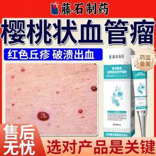 樱桃状血管瘤血管痣去除血痣毛细血管瘤皮肤点去红痣药房同款膏BS