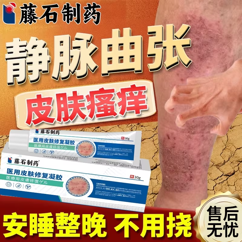 静脉曲张皮肤瘙痒症专用小腿止痒膏用什么冷敷凝胶可搭药监备案EM
