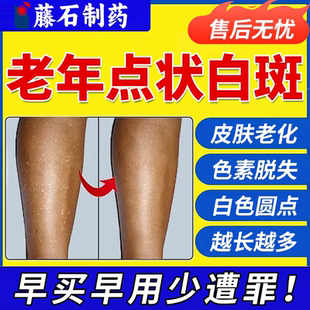 藤石制薬老年性白斑点专用修复肤色软膏特皮肤效白点特发性点状MP
