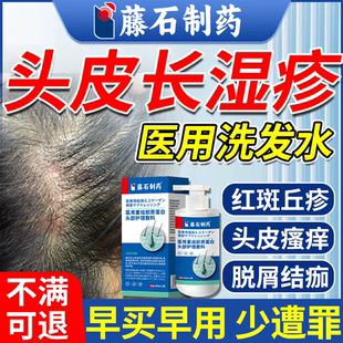 头皮湿疹头皮屑脂溢性皮炎多头痒还结痂真菌感染头癣专用洗发水JW
