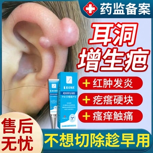耳洞增生疤痕疙瘩去除凸起硬肉耳朵消肿发炎软化瘢痕修复祛疤膏BS
