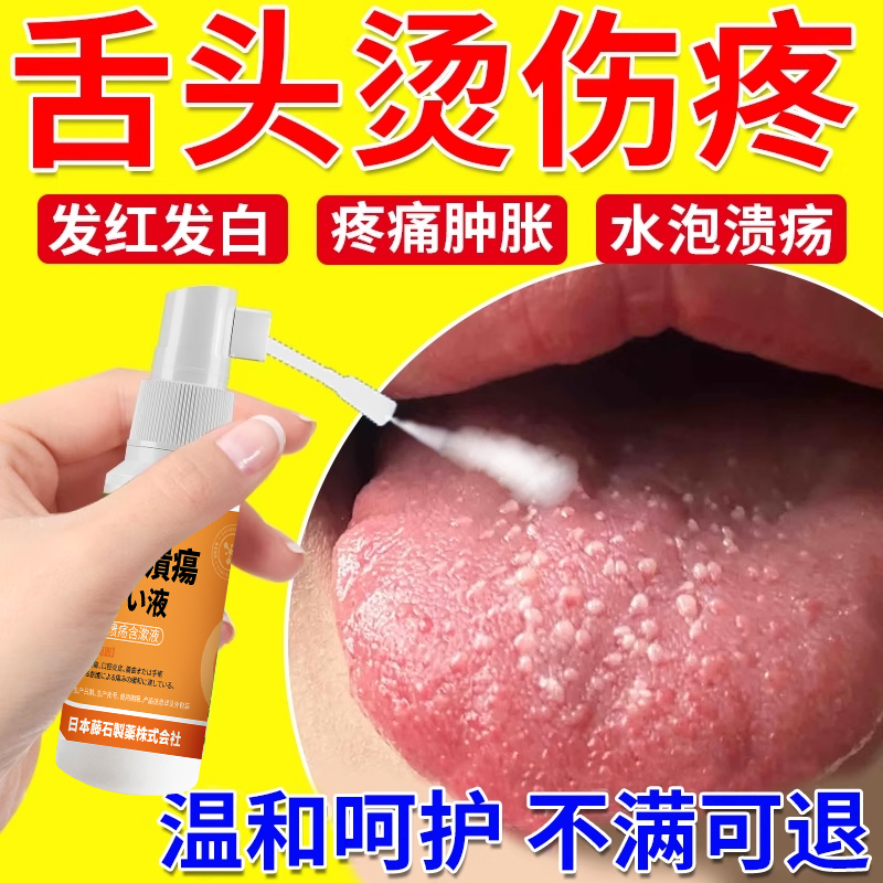 舌头热食热饮烫伤专用喷剂