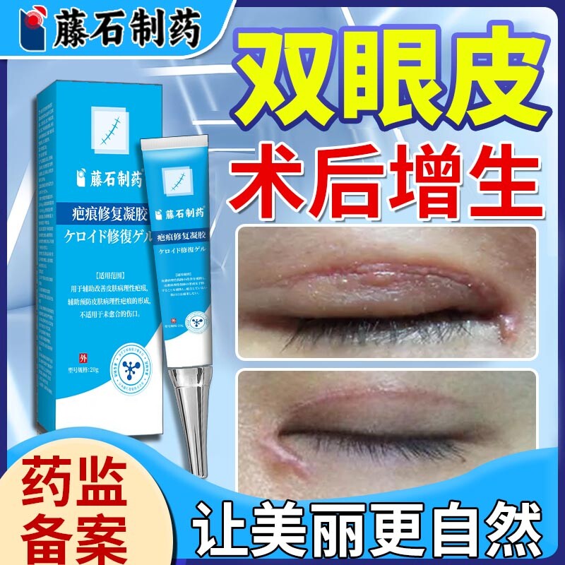 割双眼皮术后祛疤膏疤痕贴消肿神器开眼角疤痕增生凸起去除疙瘩EM