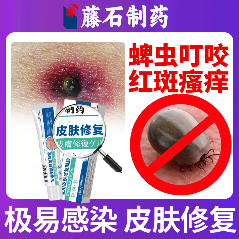 蜱虫叮咬杀虫剂蚊叮虫咬消肿止疼被跳蚤蚊子叮咬止痒药房同款膏OZ