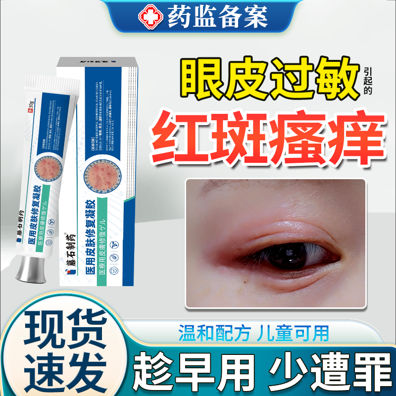眼皮红肿痒眼睛周围过敏发痒眼皮癣过敏性皮炎眼角干燥起皮掉屑JW