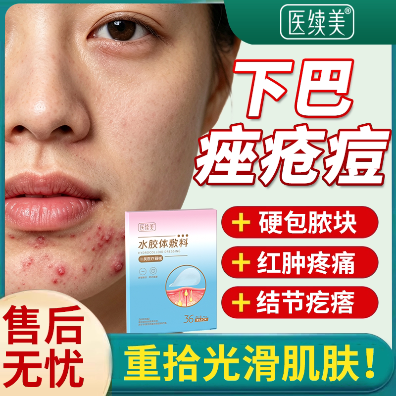 【现货速发】下巴反复痤疮痘痘贴