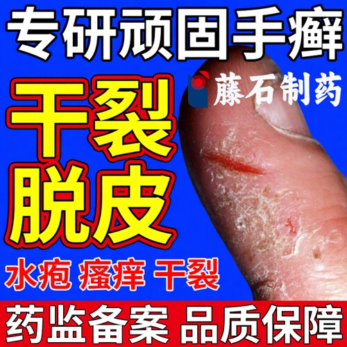 手癣克星】脱皮干裂瘙痒一次买对