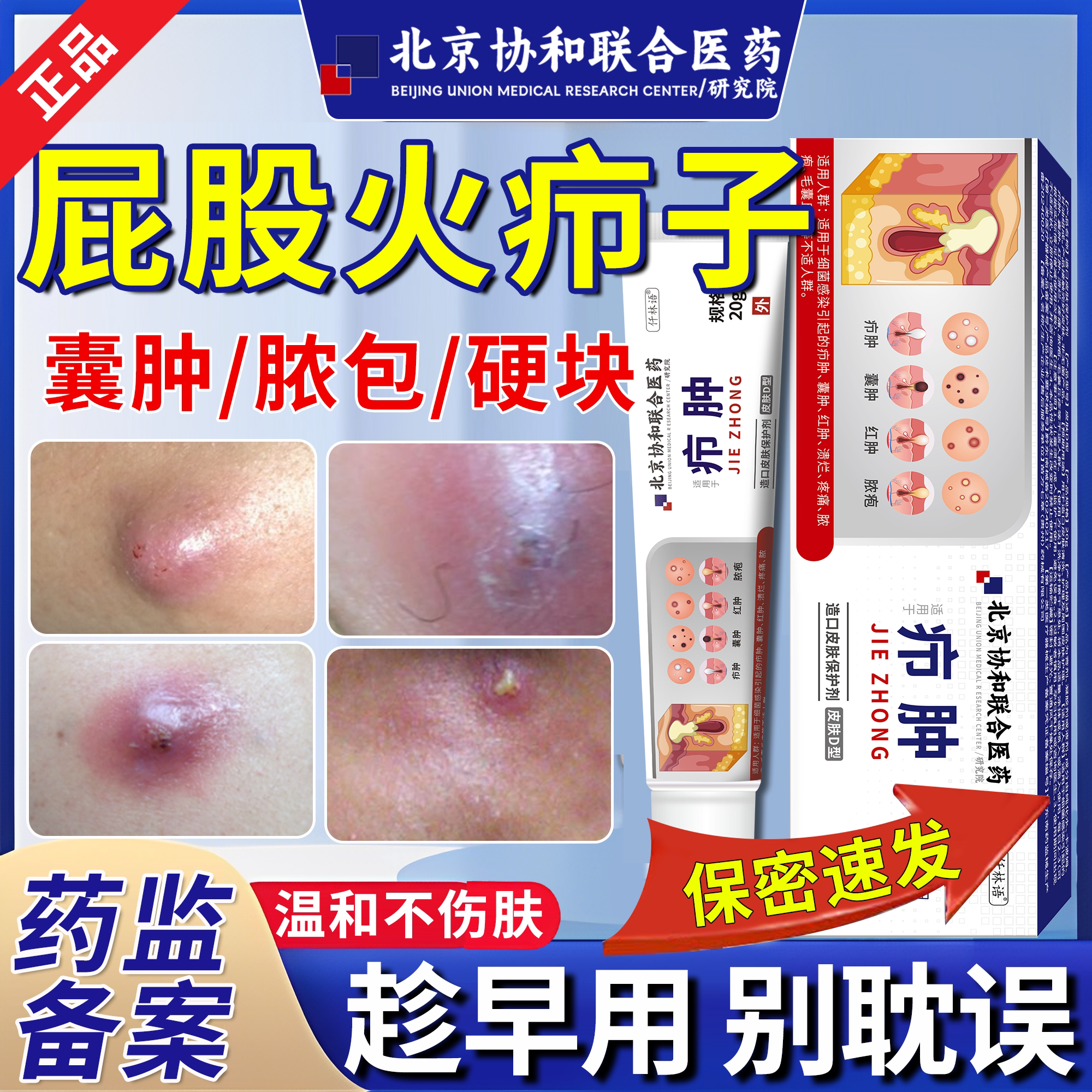 屁股上长火疖子痘痘痒起热疙瘩癣拔毒拔脓膏药贴痤疮硬块坐板疮em