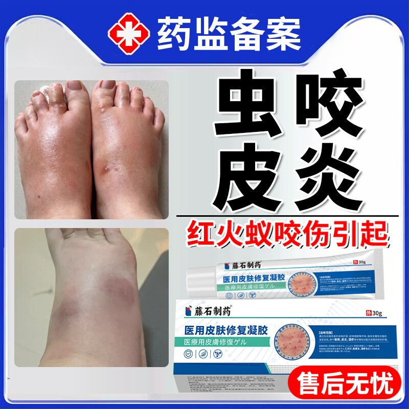 红火蚁叮咬止痒消肿克专用星被蚂蚁咬伤了擦什么药房同款膏外用BS