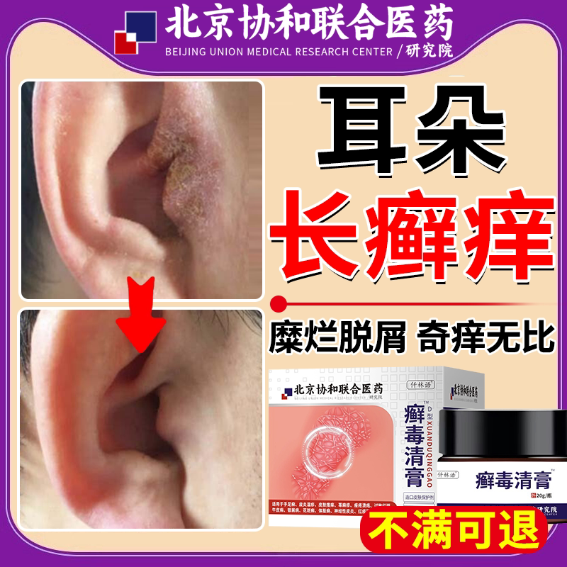耳癣药房同款膏外耳道抗真菌感染耳廓耳朵耳垂湿疹止痒去耳后根bs